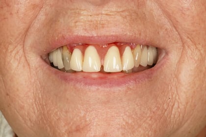 Before patient-designed replacement denture — Astro Dental, dentist in Caerphilly
