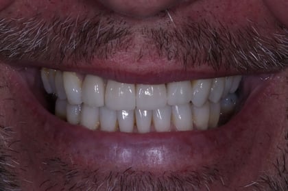 After straightened, brightened & refined — invisalign with 4 emax veneers — Astro Dental, dentist in Caerphilly