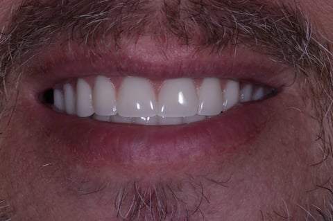 After a full reset — clearance with immediate & final upper denture — Astro Dental Llanbradach