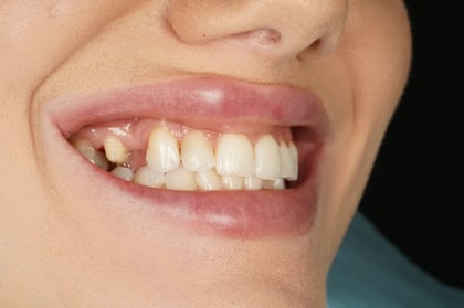 Before closing a long-standing gap with a two-unit bridge — Astro Dental, dentist in Caerphilly