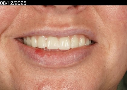 After a first smile in years — upper acrylic denture — Astro Dental, dentist in Caerphilly