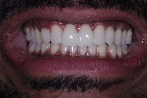 After invisalign, whitening & bonding — reshaped retained baby teeth — Astro Dental Llanbradach