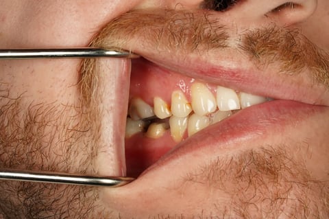 Before saved & protected — molar root canal with zirconia crown — Astro Dental Llanbradach