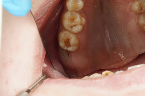 Before sensitive to bite — small cavity, composite restoration — Astro Dental Llanbradach
