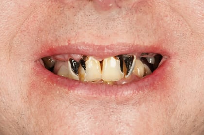 Before full mouth clearance & immediate dentures — Astro Dental, dentist in Caerphilly