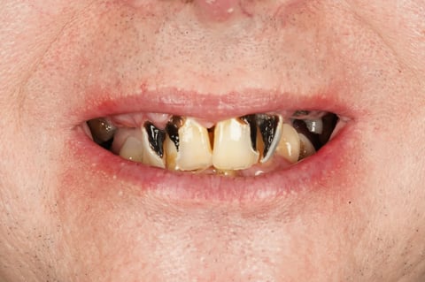 Before full mouth clearance & immediate dentures — Astro Dental Llanbradach