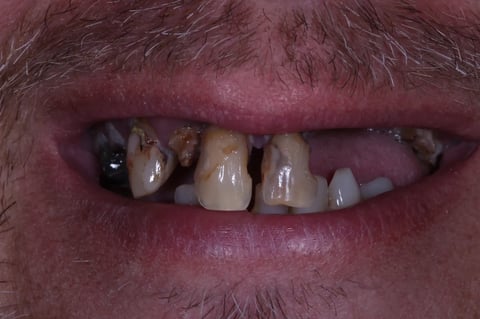 Before a full reset — clearance with immediate & final upper denture — Astro Dental Llanbradach
