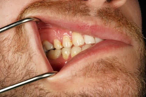 After saved & protected — molar root canal with zirconia crown — Astro Dental Llanbradach
