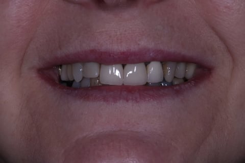 Before digital smile design — 6 layered zirconia crowns — Astro Dental Llanbradach