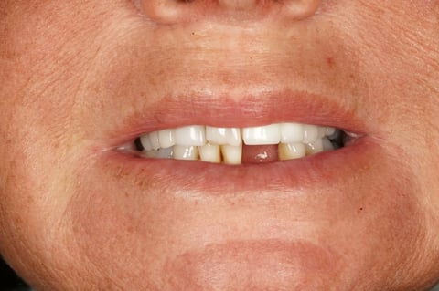 Before "nothing could be done" — small lower denture, big difference — Astro Dental Llanbradach