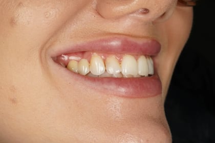 After closing a long-standing gap with a two-unit bridge — Astro Dental, dentist in Caerphilly