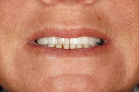 After "nothing could be done" — small lower denture, big difference — Astro Dental Llanbradach
