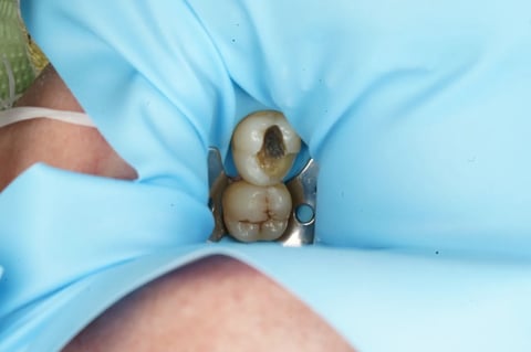 Before saving a tooth others said couldn't be saved — emax onlay — Astro Dental Llanbradach
