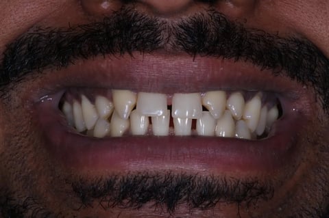 Before invisalign, whitening & bonding — reshaped retained baby teeth — Astro Dental Llanbradach