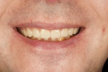 After full mouth clearance & immediate dentures — Astro Dental, dentist in Caerphilly