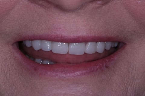 After severe wear restored — 8 zirconia crowns — Astro Dental Llanbradach