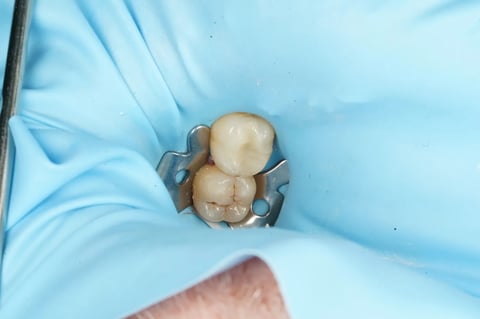 After saving a tooth others said couldn't be saved — emax onlay — Astro Dental Llanbradach