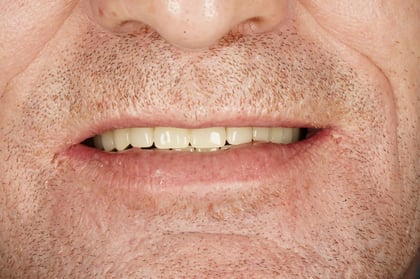 After full mouth reset — upper & lower dentures after clearance — Astro Dental, dentist in Caerphilly