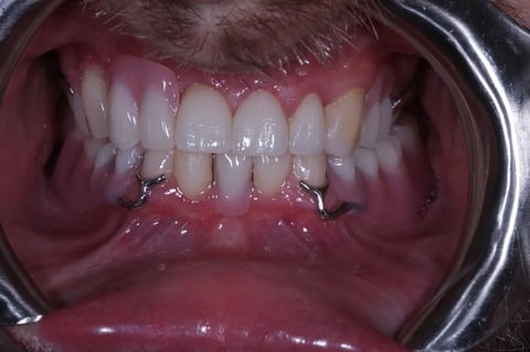 After full smile rehabilitation — crowns, bonding & cobalt chrome dentures — Astro Dental Llanbradach
