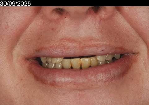 Before a fresh start — upper clearance with lower hygiene — Astro Dental Llanbradach