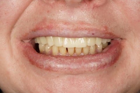 After a fresh start — upper clearance with lower hygiene — Astro Dental Llanbradach