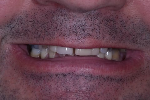 Before refreshed & rebuilt — whitening with 6 emax crowns — Astro Dental Llanbradach