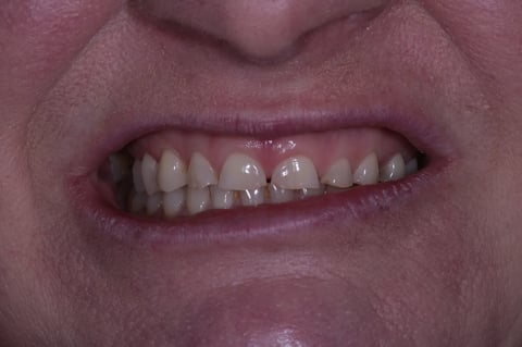 Before severe wear restored — 8 zirconia crowns — Astro Dental Llanbradach