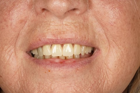 After patient-designed replacement denture — Astro Dental Llanbradach