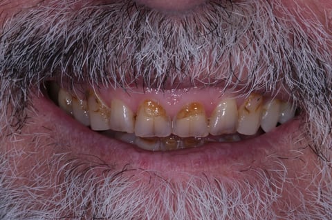 Before rebuilt & refreshed — composite bonding on 6 front teeth — Astro Dental Llanbradach