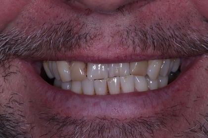Before straightened, brightened & refined — invisalign with 4 emax veneers — Astro Dental, dentist in Caerphilly