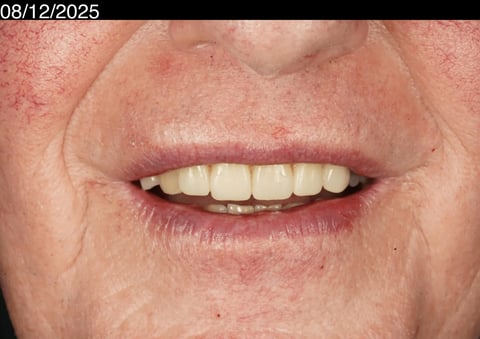 After a more secure smile — cobalt chrome denture — Astro Dental Llanbradach