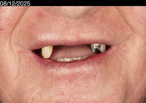 Before a more secure smile — cobalt chrome denture — Astro Dental Llanbradach