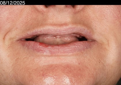 Before a first smile in years — upper acrylic denture — Astro Dental, dentist in Caerphilly