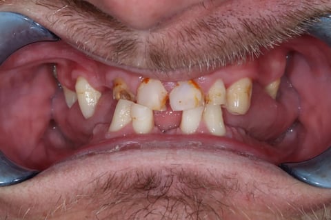 Before full smile rehabilitation — crowns, bonding & cobalt chrome dentures — Astro Dental Llanbradach