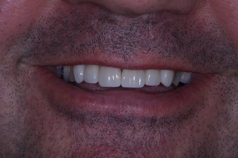 After refreshed & rebuilt — whitening with 6 emax crowns — Astro Dental Llanbradach