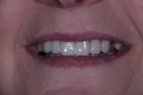 After digital smile design — 6 layered zirconia crowns — Astro Dental Llanbradach