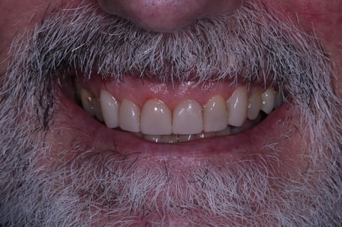 After rebuilt & refreshed — composite bonding on 6 front teeth — Astro Dental Llanbradach