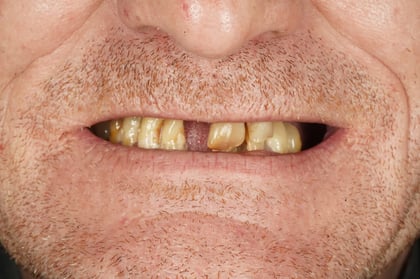 Before full mouth reset — upper & lower dentures after clearance — Astro Dental, dentist in Caerphilly