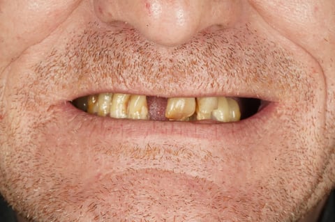 Before full mouth reset — upper & lower dentures after clearance — Astro Dental Llanbradach