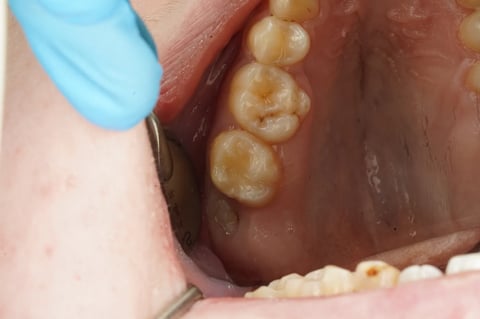 After sensitive to bite — small cavity, composite restoration — Astro Dental Llanbradach